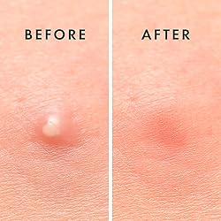 Rael Pimple Patches, Miracle Invisible Spot Cover