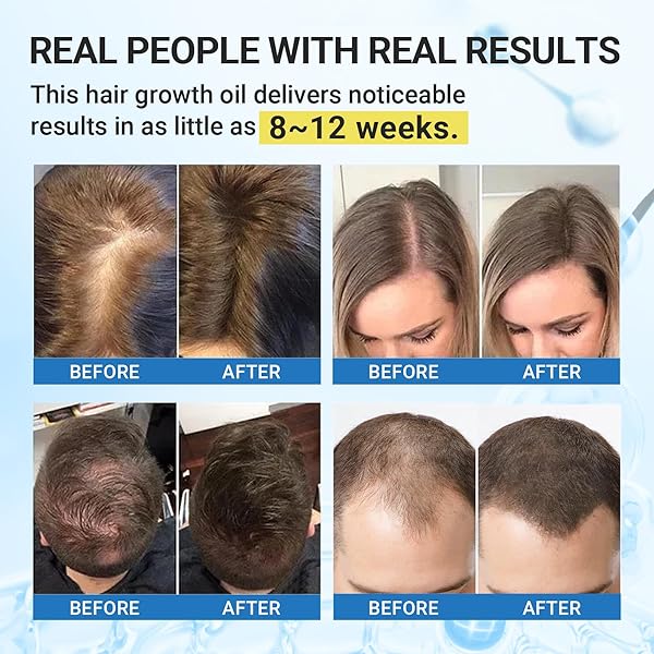 GIOTTO HAIR GROWTH SERUM WITH BIOTIN, ROSEMARY, BATANA OIL, CASTOR OIL & RICE WATER, LIGHTWEIGHT AND NATURAL FORMULA REDUCES HAIR LOSS, NOURISH SCALP, EFFECTIVE HAIR THICKENING FOR WOMEN MEN