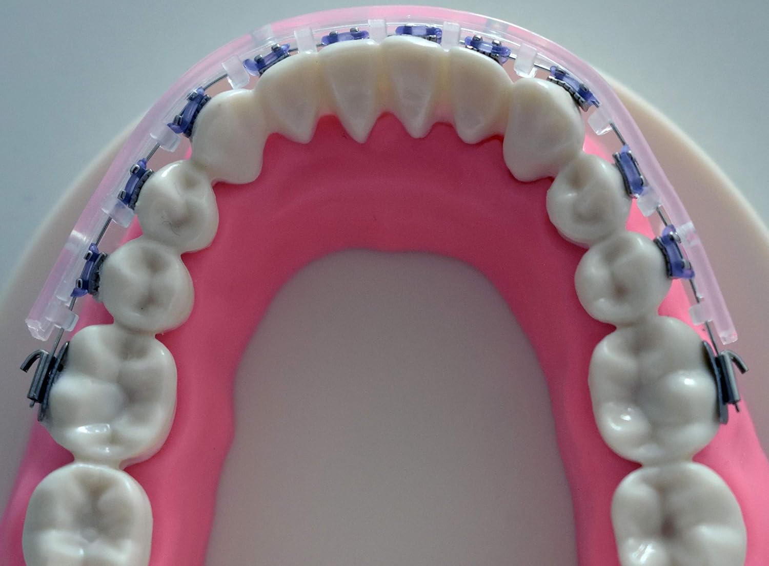 TecnidentUSA Clip-On Comfort Lip Shield/Mouth Protector Guard For Braces - Orthodontic Dental Wax Alternative - 2019 New and Improved : Beauty