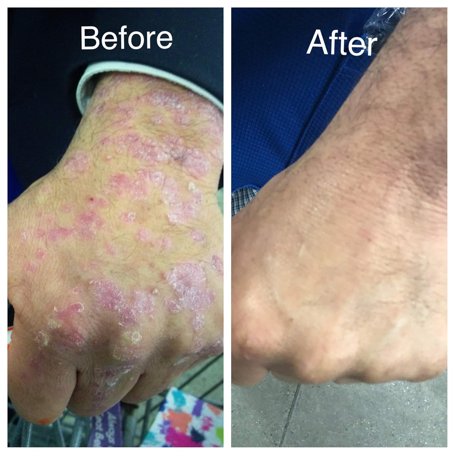 Amazon Com Psoriasis Soap Result Mitlow Herbal Soap Helps Eczema Psoriasis It Really Works Chemical Free Organic All Natural Handmade 3 5 Oz Handmade