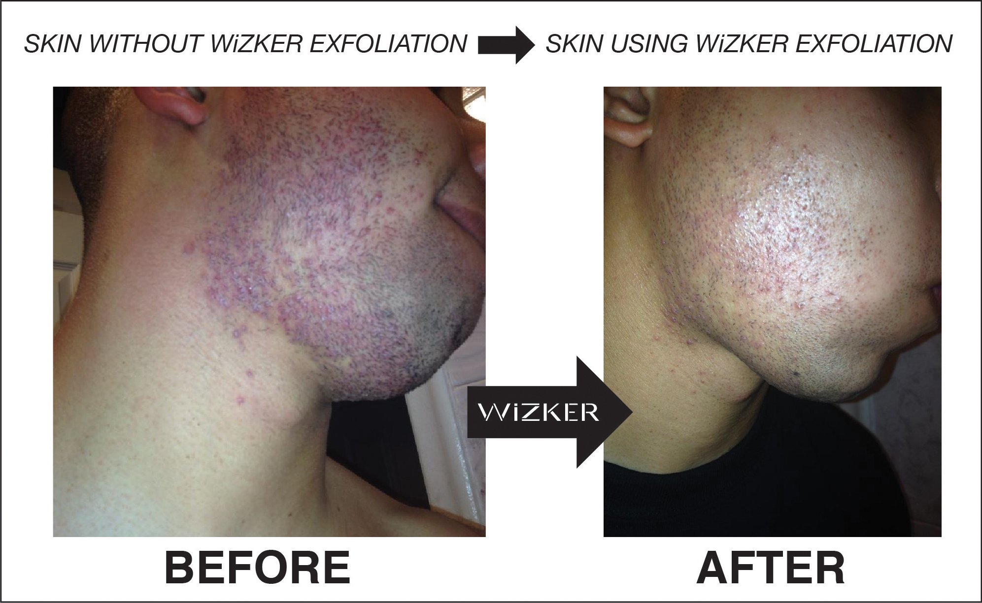 Waterproof Exfoliating Brush Stops Ingrown Hair Razor Bumps