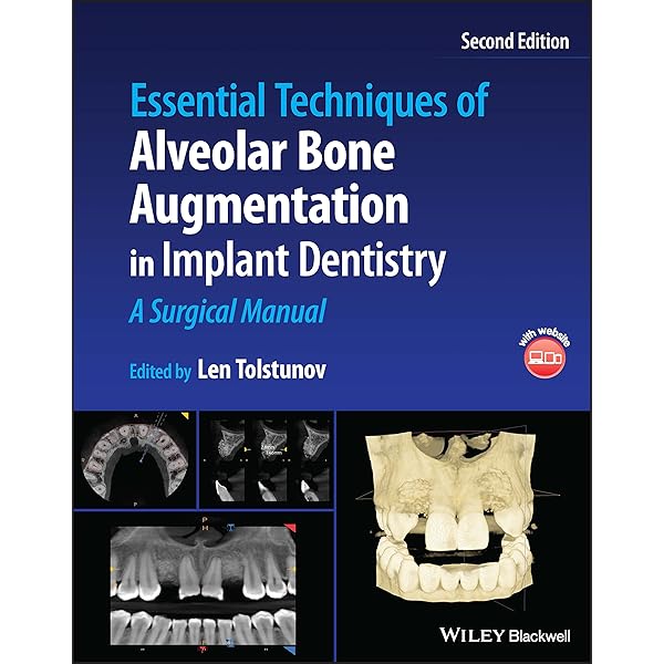 Essential Techniques of Alveolar Bone Augmentation in Implant