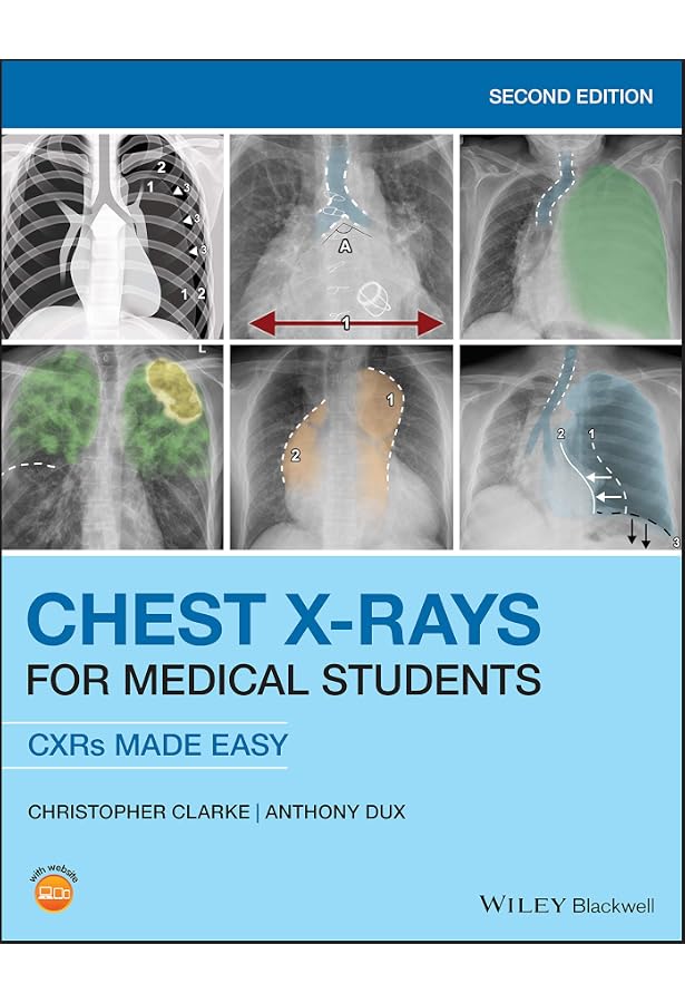 The Basics Of Chest X Ray Interpretation Drbeen Basic Chest X Ray