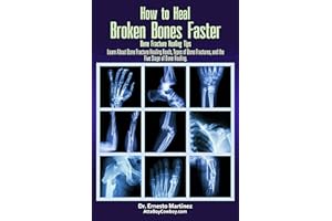 How to Heal Broken Bones Faster. Bone Fracture Healing Tips: Learn About Bone Fracture Healing Foods, Types of Bone Fractures