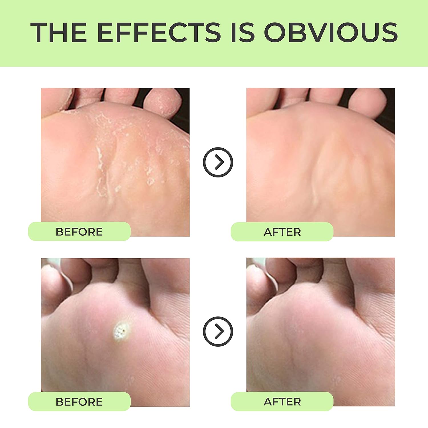 Corn Removers For Feet Callus Remover Pads For Foot Corns Removal Pad For Toe Corn & Callus Relief Plaster For Toes Kit of 42 pcs : Beauty