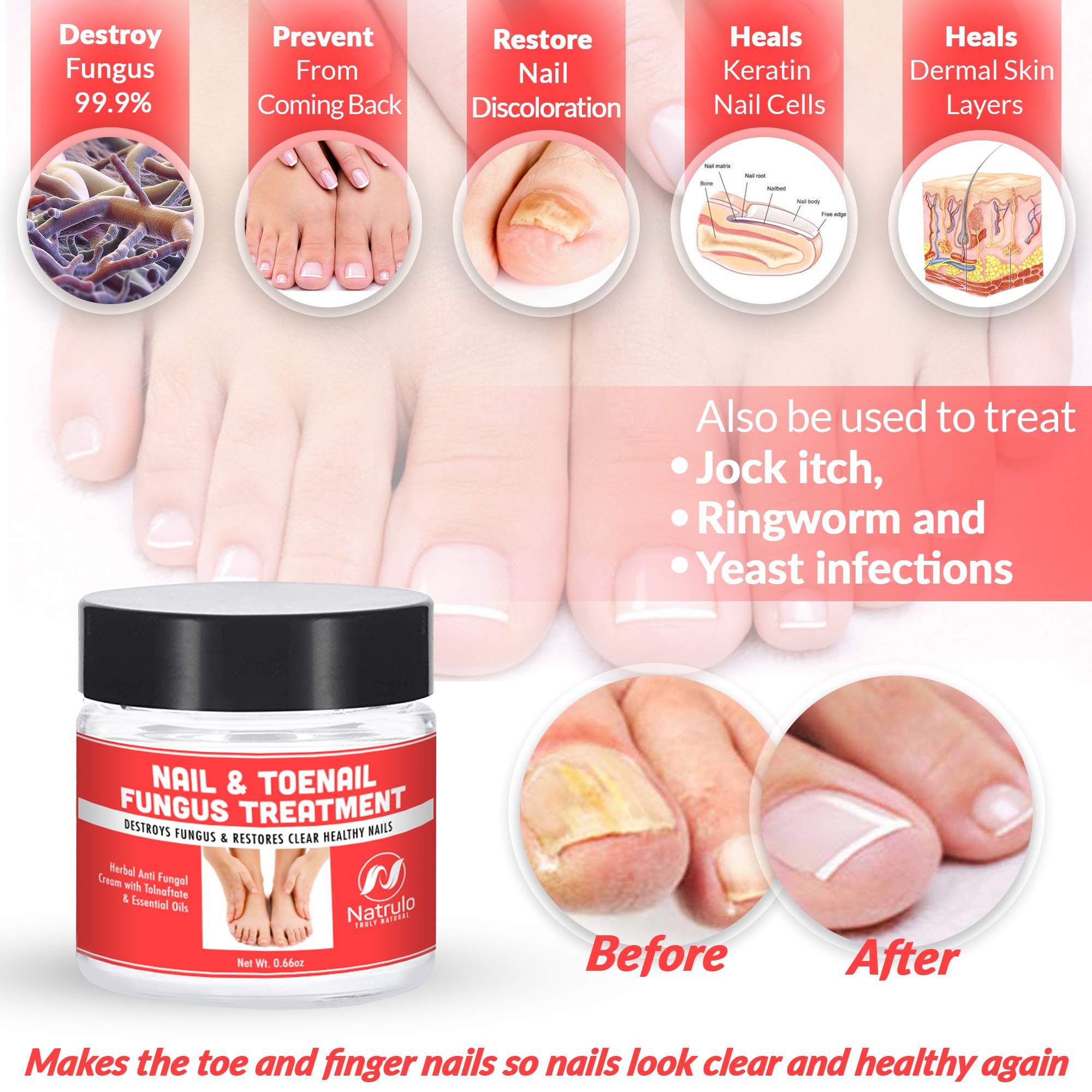 Natrulo Nail & Toenail Fungus Treatment Herbal Anti Fungal Cream with