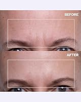 WRINKLES Forehead Patches 1-Pack Reusable Silicone Skin Care view 3