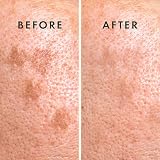 Rael Pimple Patches Miracle Microcrystal Vitamin C Dark Spot Cover 9 Count view 5
