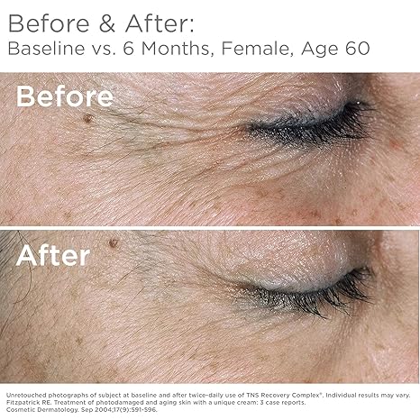 tns recovery complex