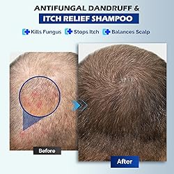 Antifungal Shampoo for Seborrheic