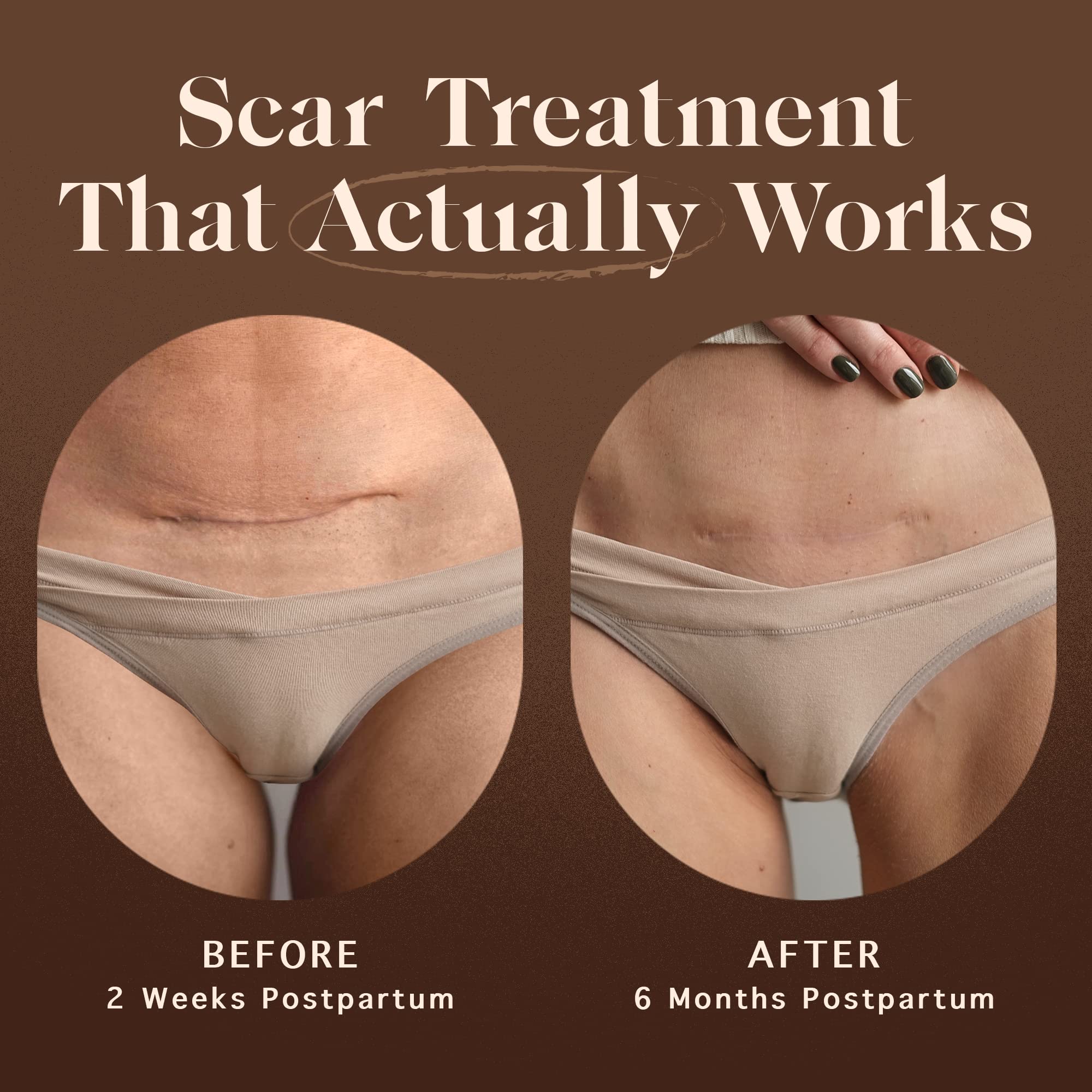 Nemah - Restorative Scar Treatment for C Section Recovery - C Section Scar Treatment for Postpartum - Reduces the Appearance of Scars from Acne - Vegan & Cruelty-Free - 1 oz.