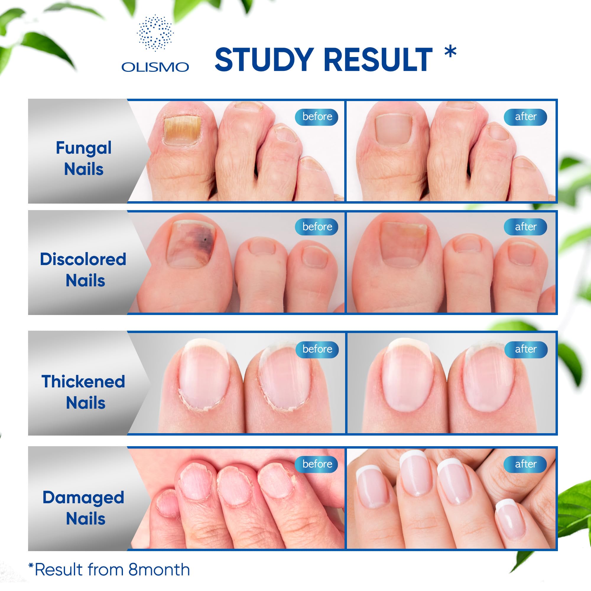 Toenail Fungus Treatment, Nail Fungus Treatment for Toenail, Toe Nail Fungus Treatment Extra Strength for Woman and Man, Nail Fungus Treatment 30ML (1 FLOZ) - Image 5