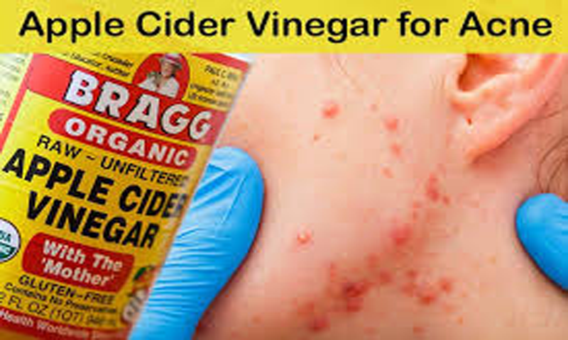 Apple Cider Vinegar: Benefits, uses, For Treatment Of Infections. - Thumbnail 2