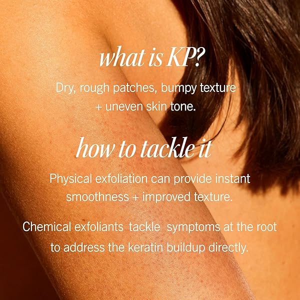 FIRST AID BEAUTY – KP BUMP ERASER BODY SCRUB WITH 10% AHA, KERATOSIS PILARIS SKIN EXFOLIATER WITH GLYCOLIC AND LACTIC ACIDS, HELPS REDUCE CHICKEN SKIN BUMPS, SAFE FOR SENSITIVE SKIN, 10 OZ