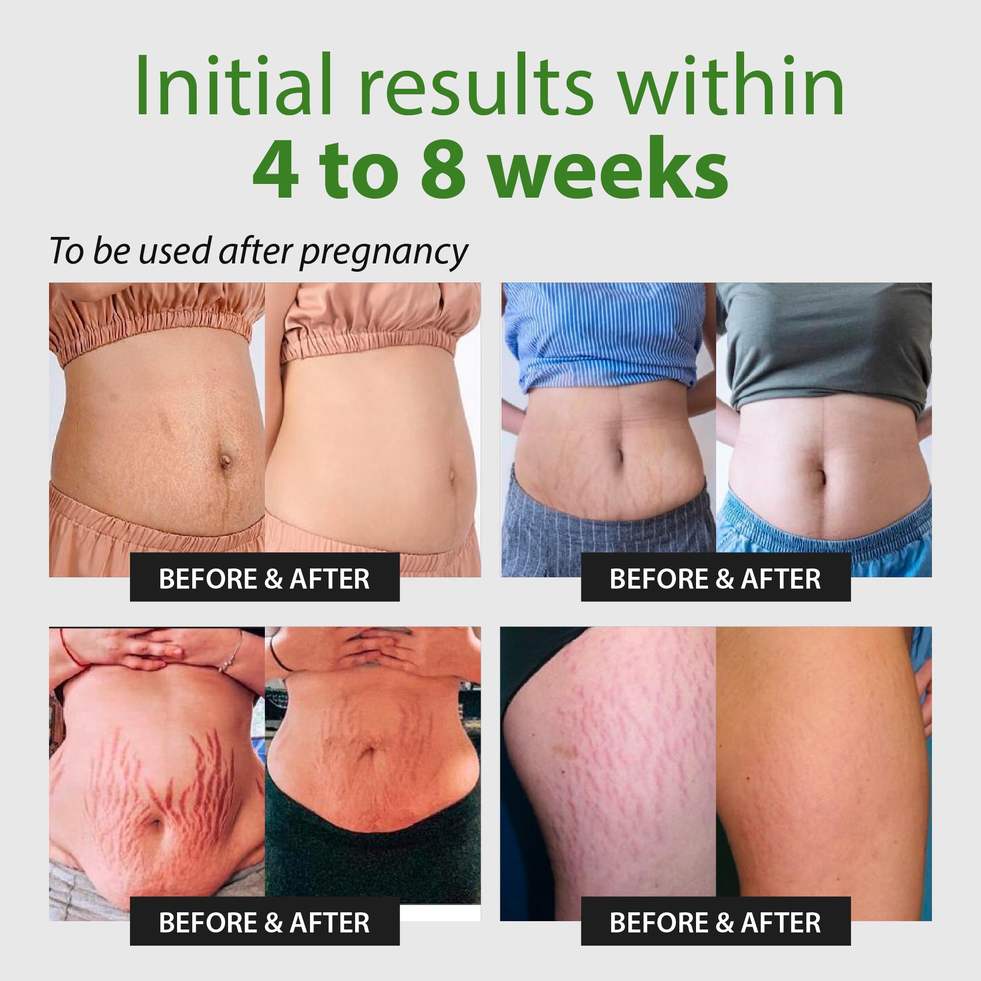 Abera Maternity Stretch Mark Cream for Pregnancy and Weight Fluctuations, Stretch Mark Treatment Pregnancy Must Haves, Deep Stretch Mark Removal