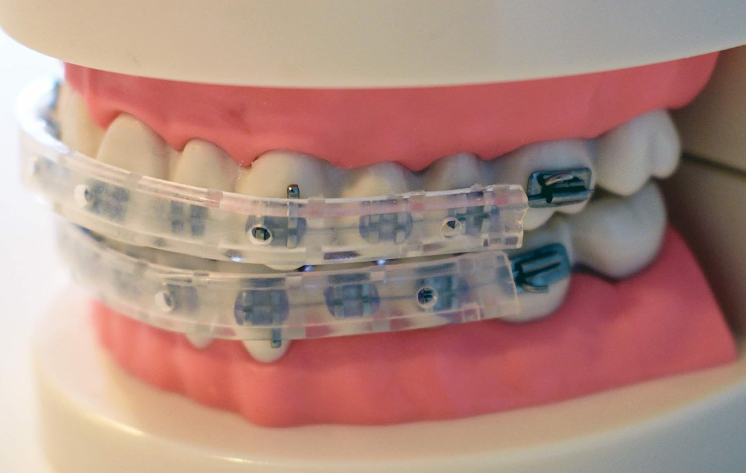 TecnidentUSA Clip-On Comfort Lip Shield/Mouth Protector Guard For Braces - Orthodontic Dental Wax Alternative - 2019 New and Improved : Beauty