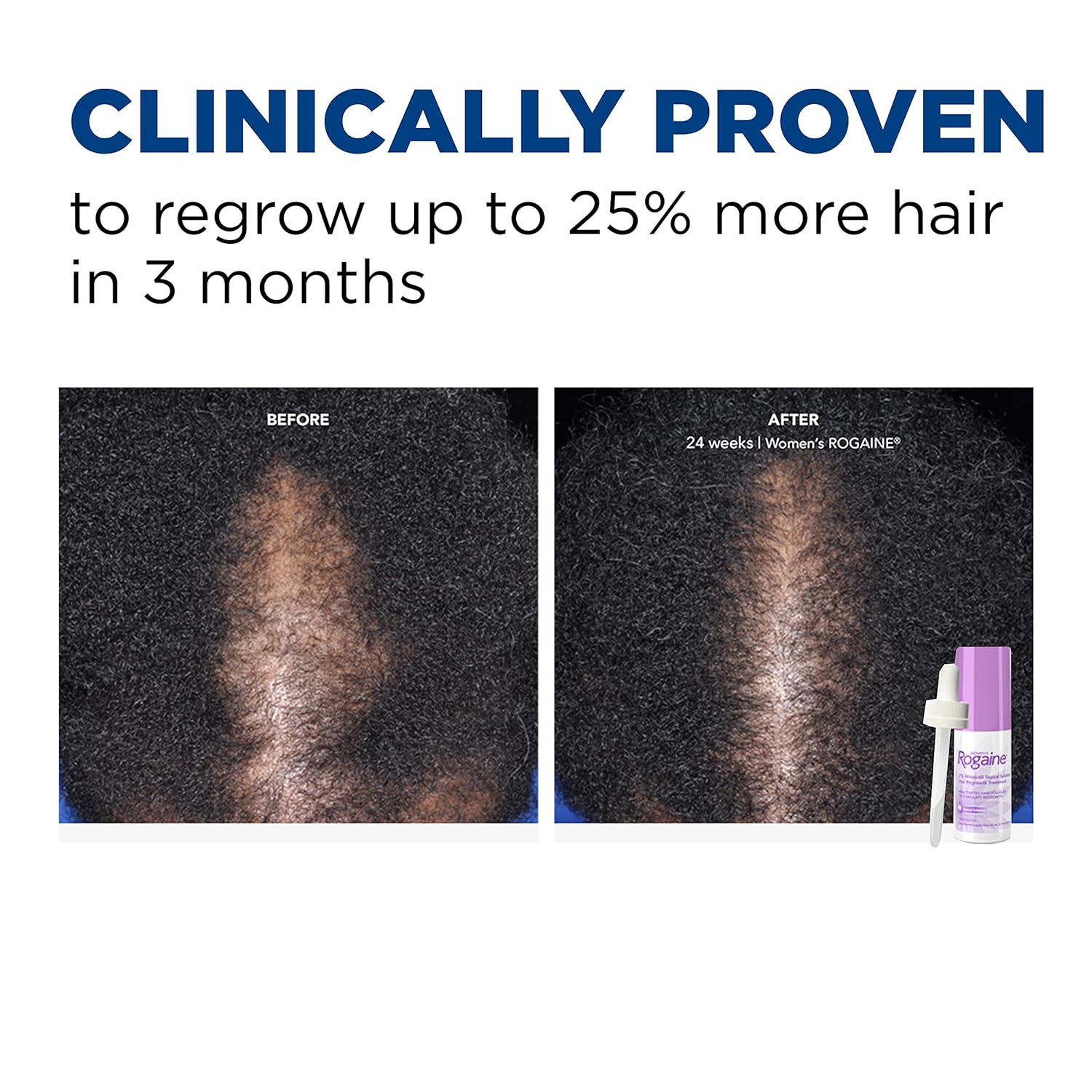 Women's Rogaine 2% Minoxidil Topical Solution for Hair Thinning and Loss, Topical Treatment for Women's Hair Regrowth, 1-Month Supply : Beauty