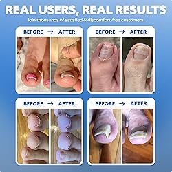 CurveCorrect® Ingrown Toenail Treatment Kit