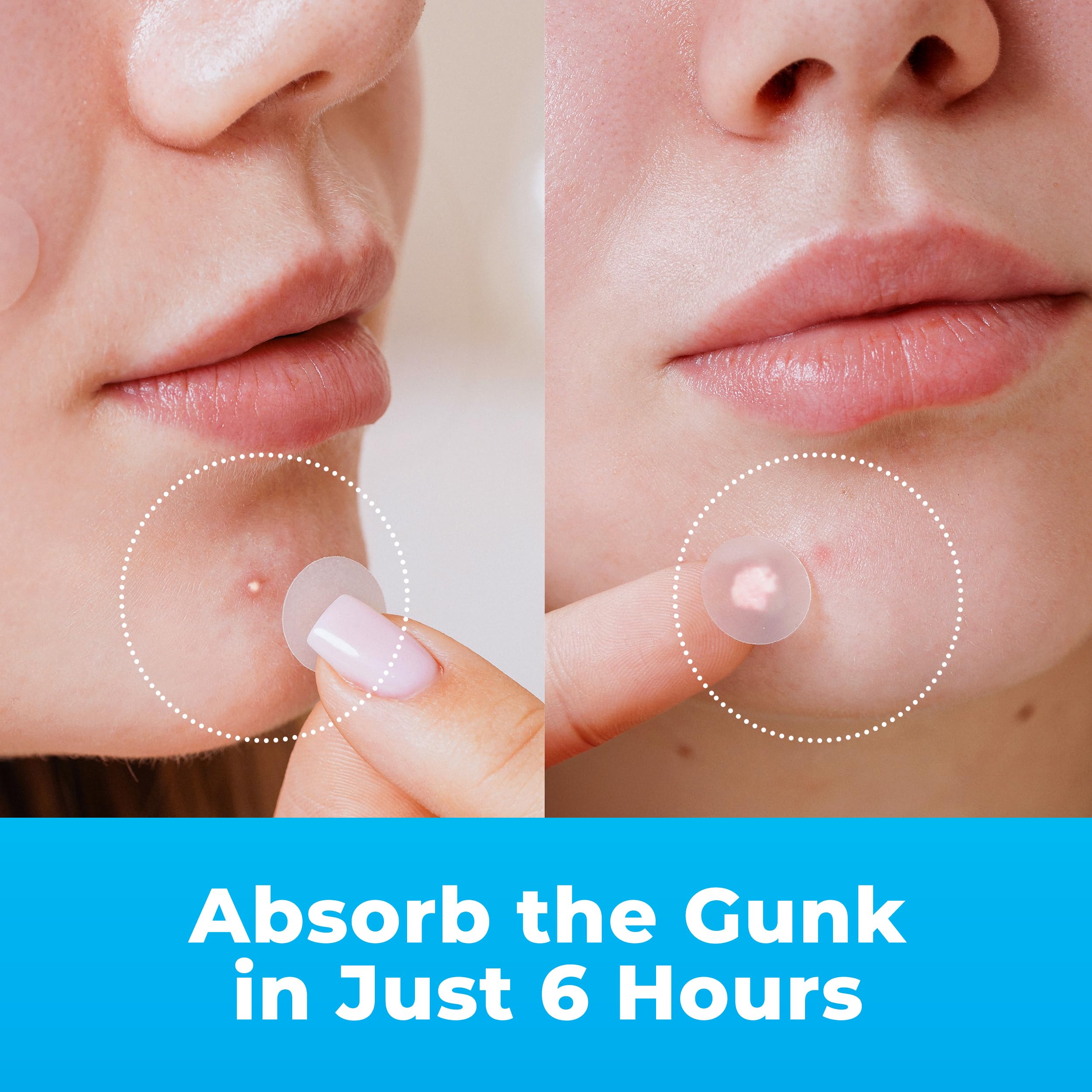 Pimple Patches for Face (120 Patches), Hydrocolloid Acne Patches with Tea Tree Oil, Pimple Patch Pimple Stickers - Hydrocolloid Patch Acne Dots - Acne Pimple Patches For Face - Zit Patches