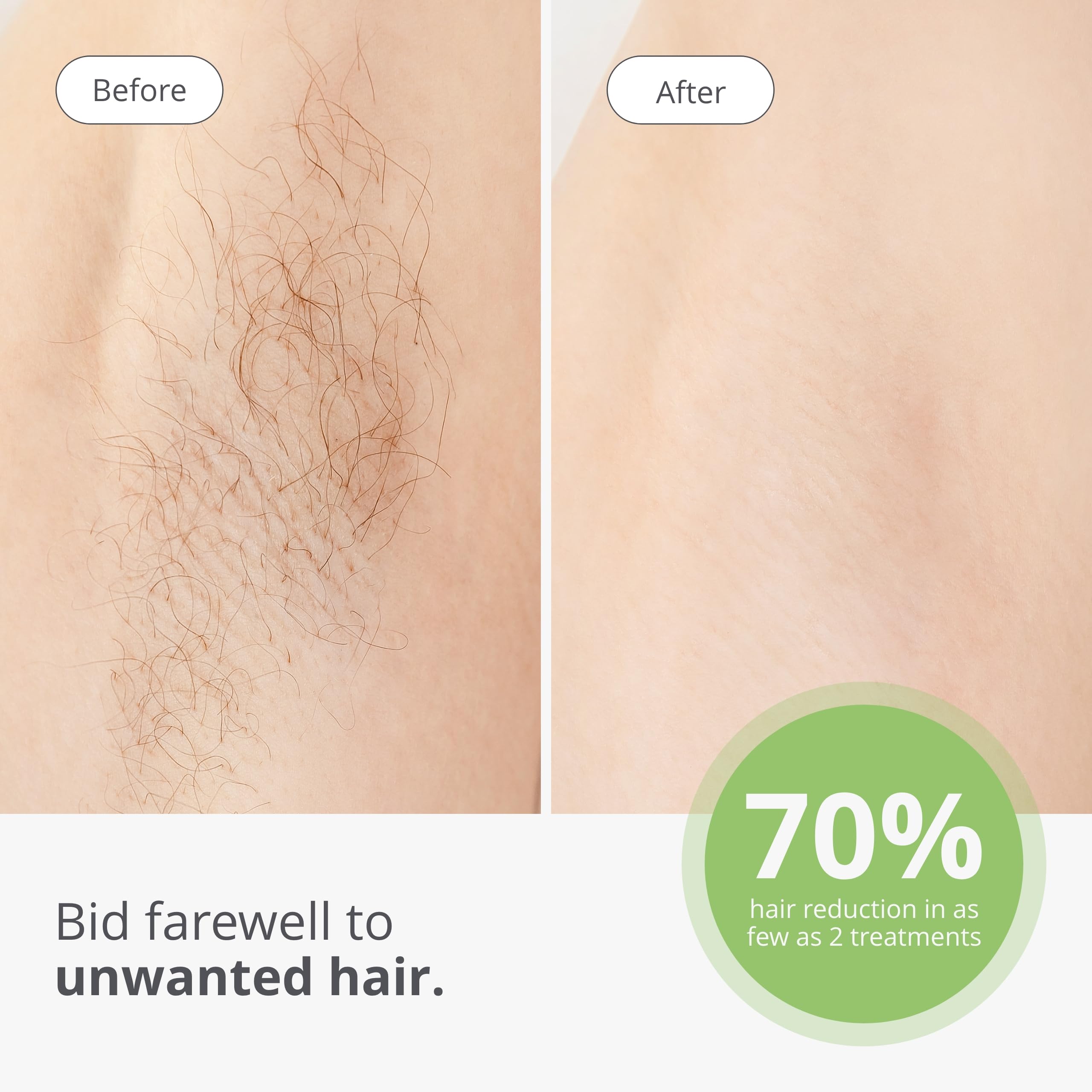 TRIA Beauty Laser Hair Removal Device 4X - Cordless at Home Laser Hair Removal for Women and Men, 3X the Energy Density of IPL Hair Removal