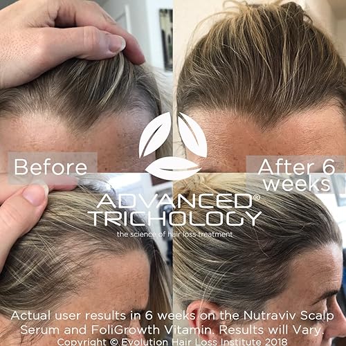 Nutraviv Hair Growth Serum Powerful Hair Loss Treatments For