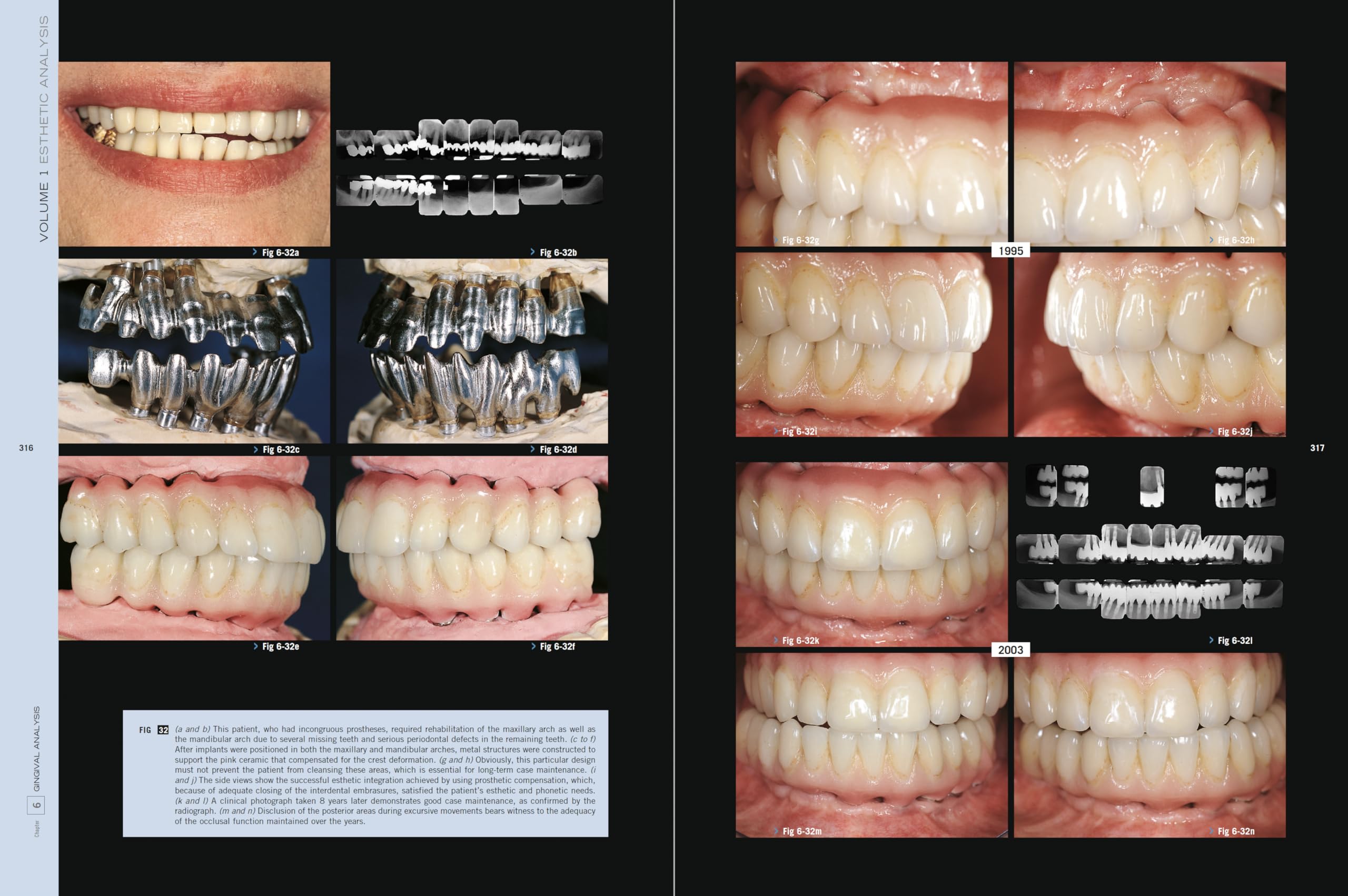 Esthetic Rehabilitation In Fixed Prosthodontics: Esthetic Analysis: A Systematic Approach To Prosthetic Treatment Esthetic Rehabilitation In Fixed Prosthodontics: Esthetic Analysis: A Systematic Approach To Prosthetic Treatment Hardcover