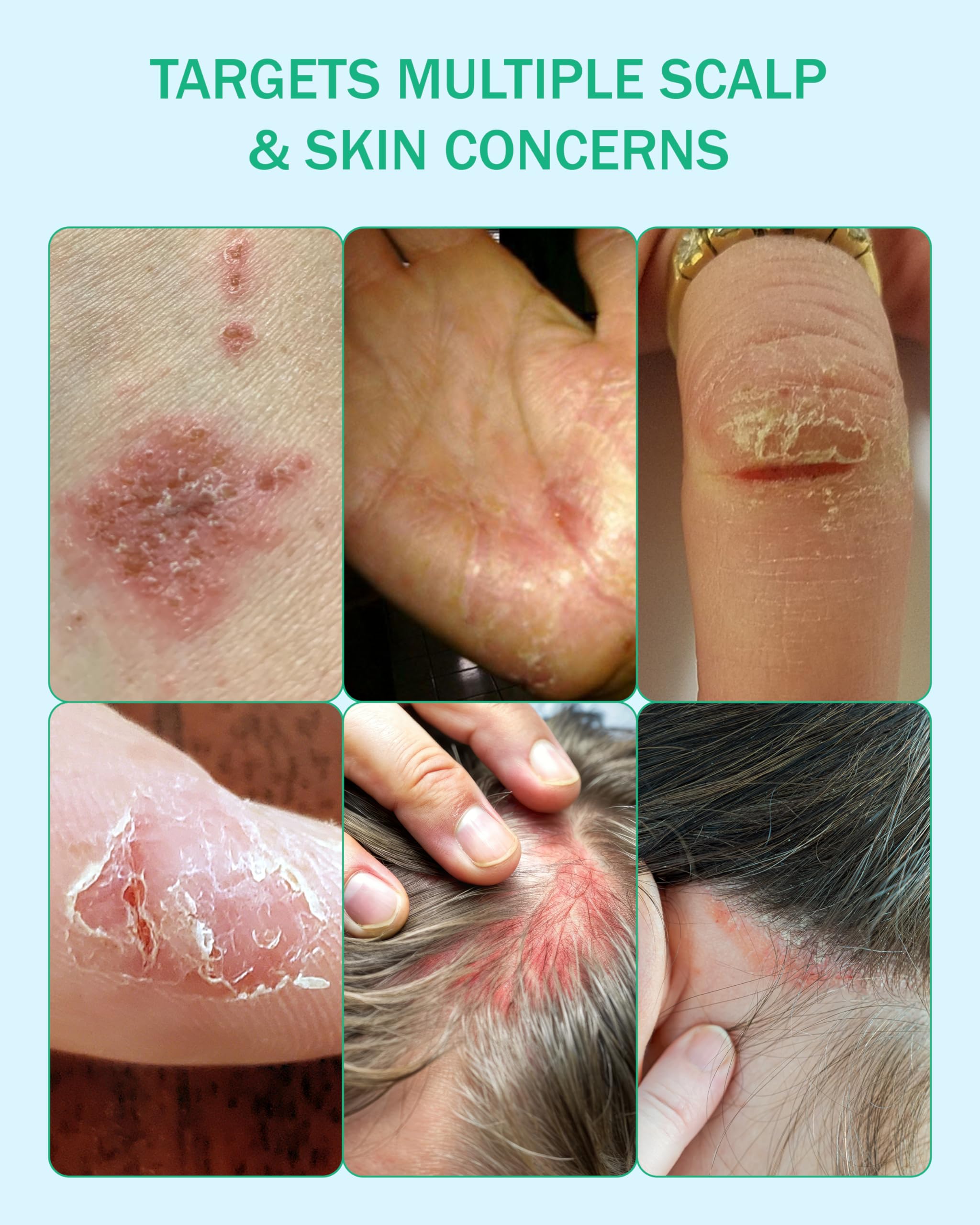 Eczema Cream for Kids & Adults, Colloidal Oatmeal & Colostrum Daily Moisturizing Body Lotion for Sensitive Skin, Soothing Eczema Treatment Relief for Dry & Itchy Skin, Steroid- & Fragrance-Free, 4 oz