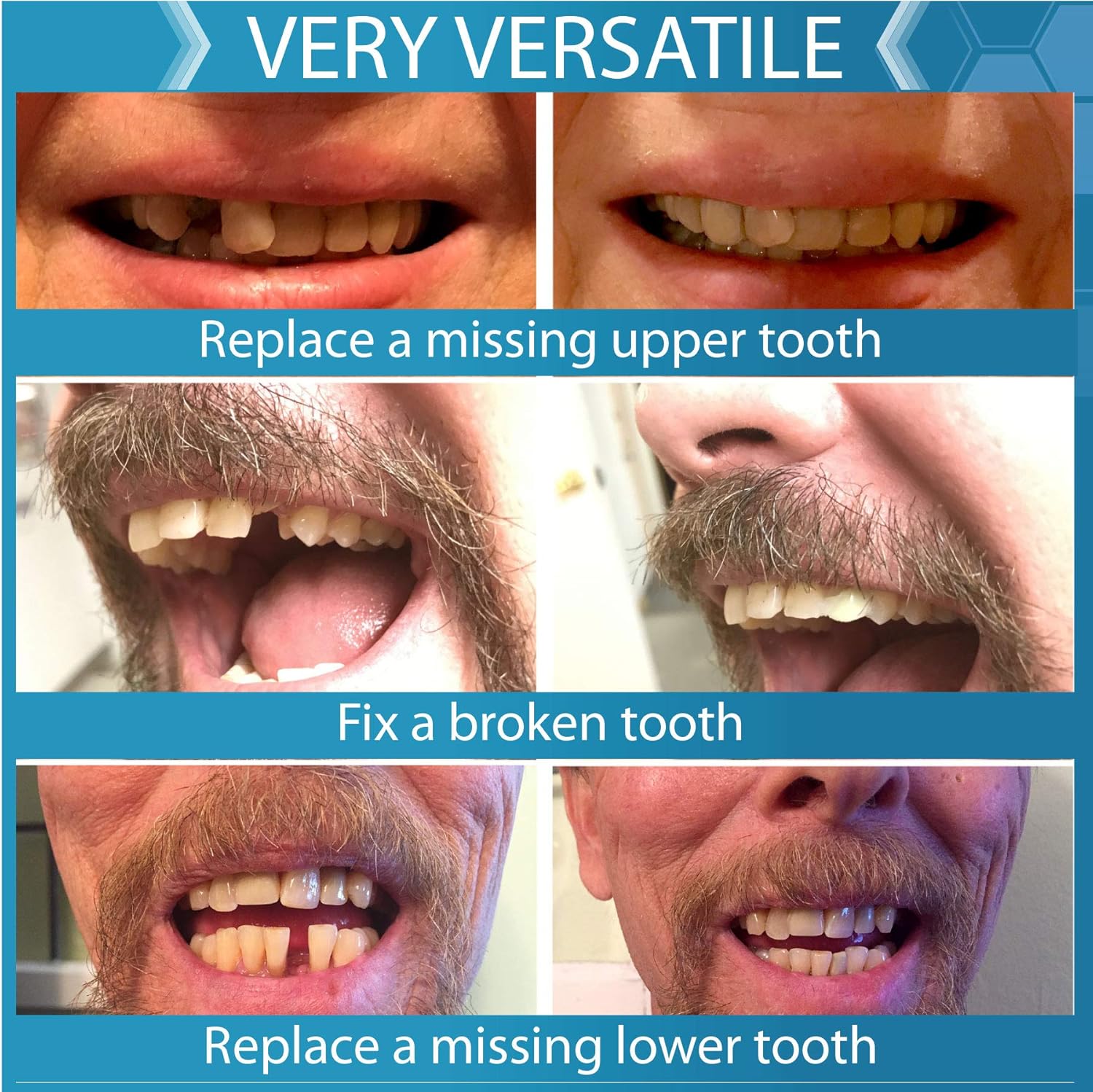 Instant Smile Complete Your Smile Temporary Tooth Replacement Kit - Replace a missing tooth in minutes - Patented : Beauty