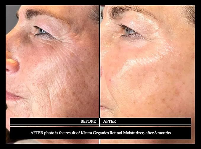 kleem retinol