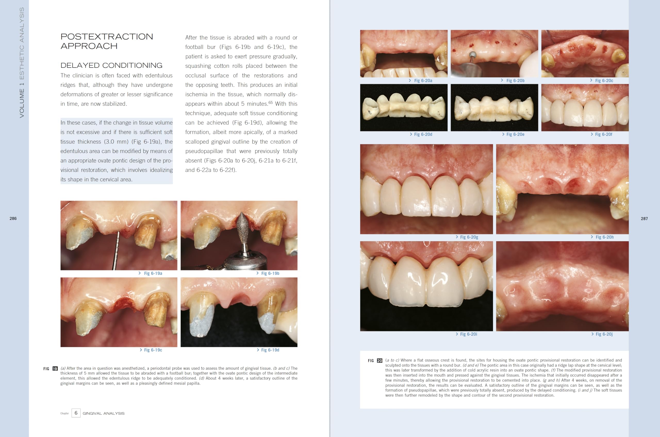Esthetic Rehabilitation In Fixed Prosthodontics: Esthetic Analysis: A Systematic Approach To Prosthetic Treatment Esthetic Rehabilitation In Fixed Prosthodontics: Esthetic Analysis: A Systematic Approach To Prosthetic Treatment Hardcover