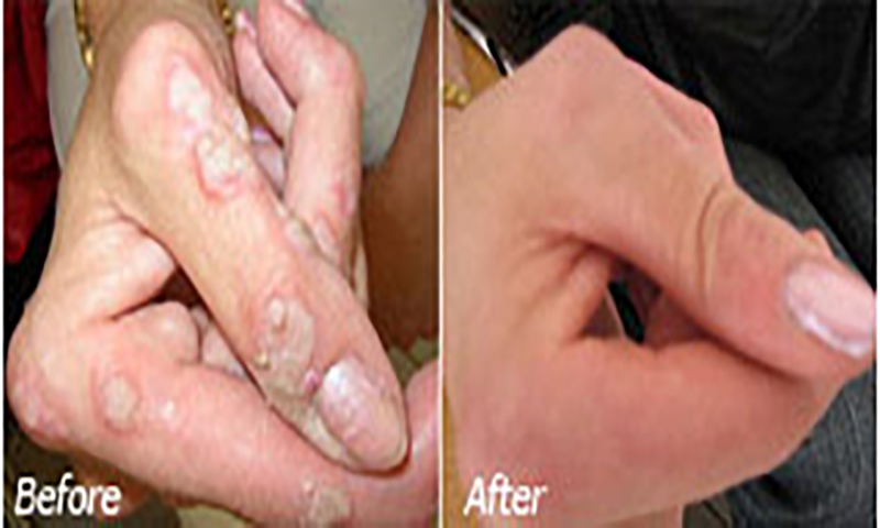 Skin Tag Removal : Discover How You Can Completely Eliminate Moles, Warts, Skin Tags Naturally