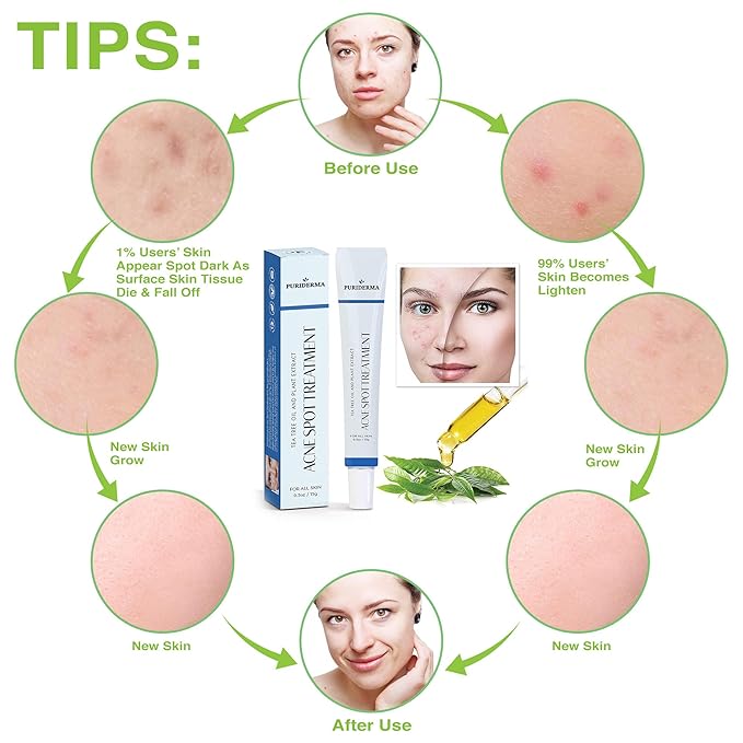 puriderma acne spot treatment