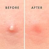 Rael Pimple Patches Miracle Overnight Spot Cover 3 Sizes 52 Count view 7