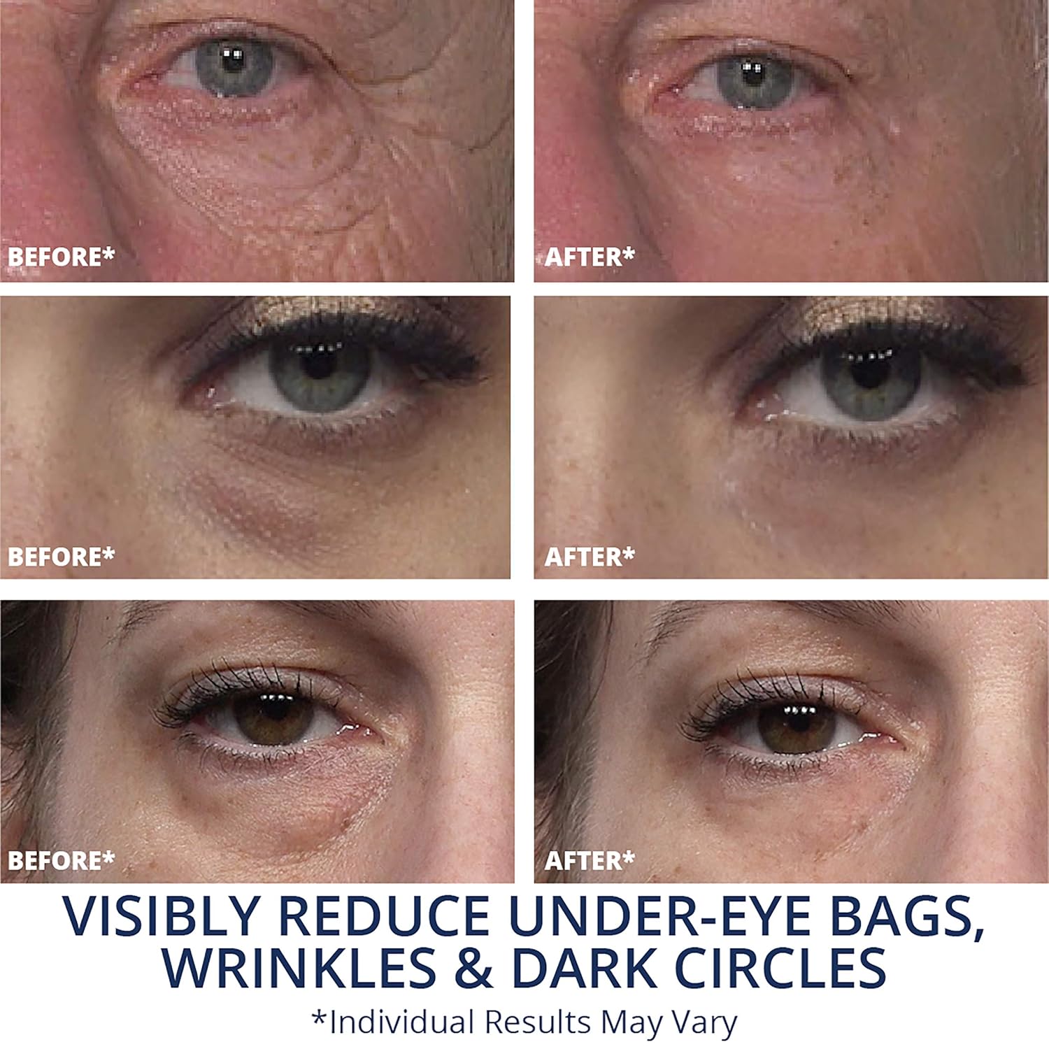 bags wrinkles under eyes