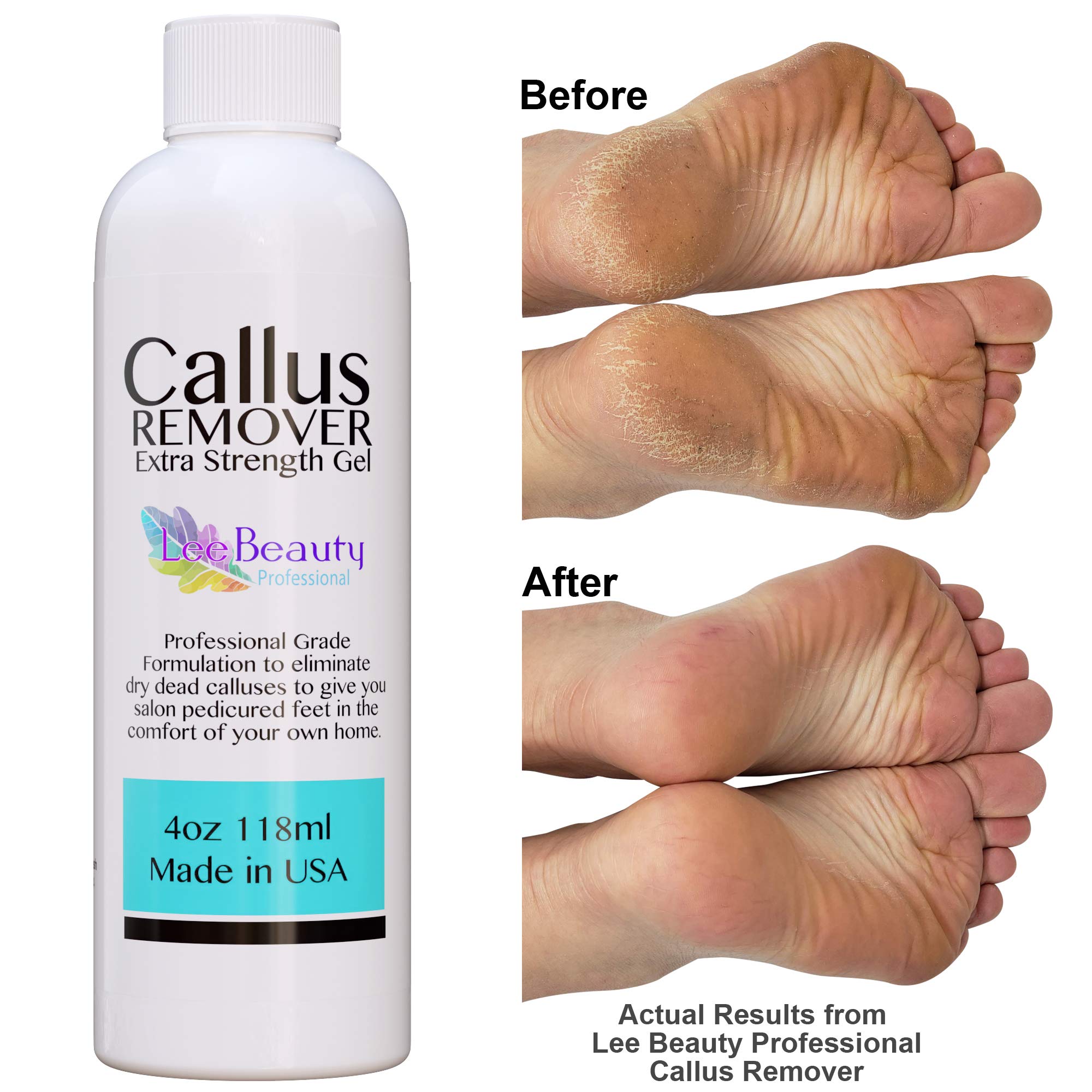 Cpt Code For Callus Removal | Wiki Pairing Corn/Callus Codes 11055 ...