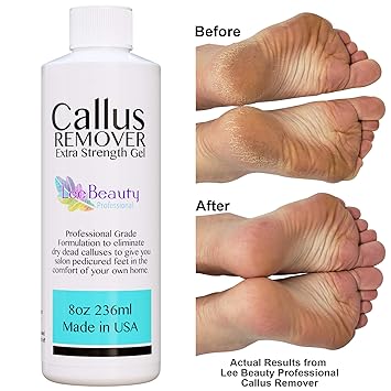 Amazon Com 8oz Callus Remover Gel For Feet For A Professional Pedicure Better Results Than Foot File Pumice Stone Foot Scrubber Foot Buckets Callus Shaver Rid Ugly Callouses From Feet In