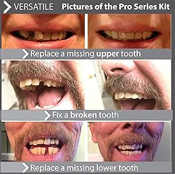 Instant Smile Flex Teeth (Natural Shade) and Pro