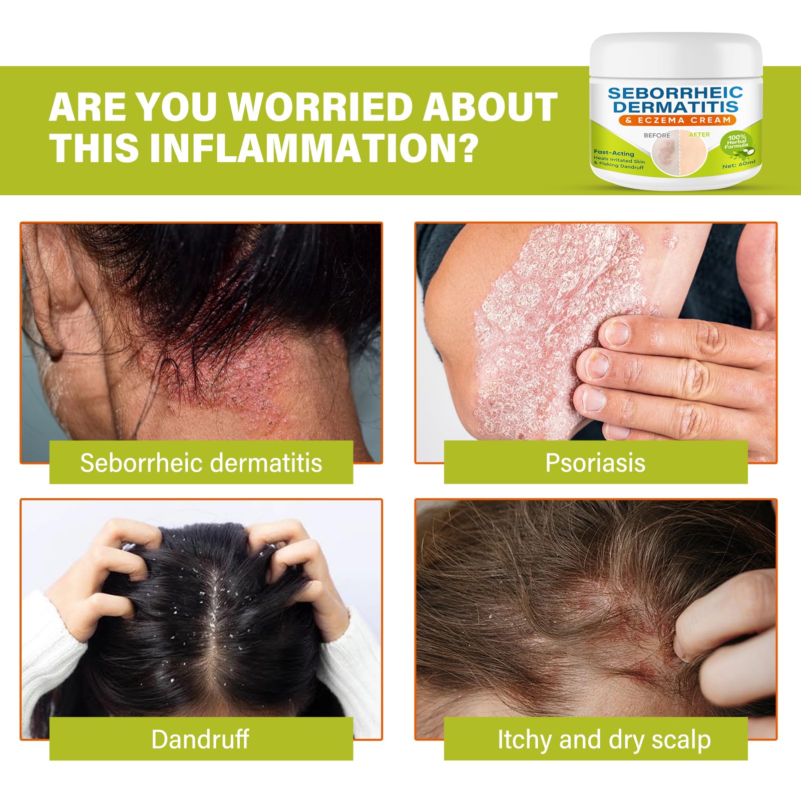 Sêborrheic Dêrmatitis Cream for Fôlliculitis Treatment, Psôriasis Rêlief for Adults, Premium Eczêma Lotion for Dândruff Treatment and Effective Rêlief Îtchy Skin, 2.1 Oz