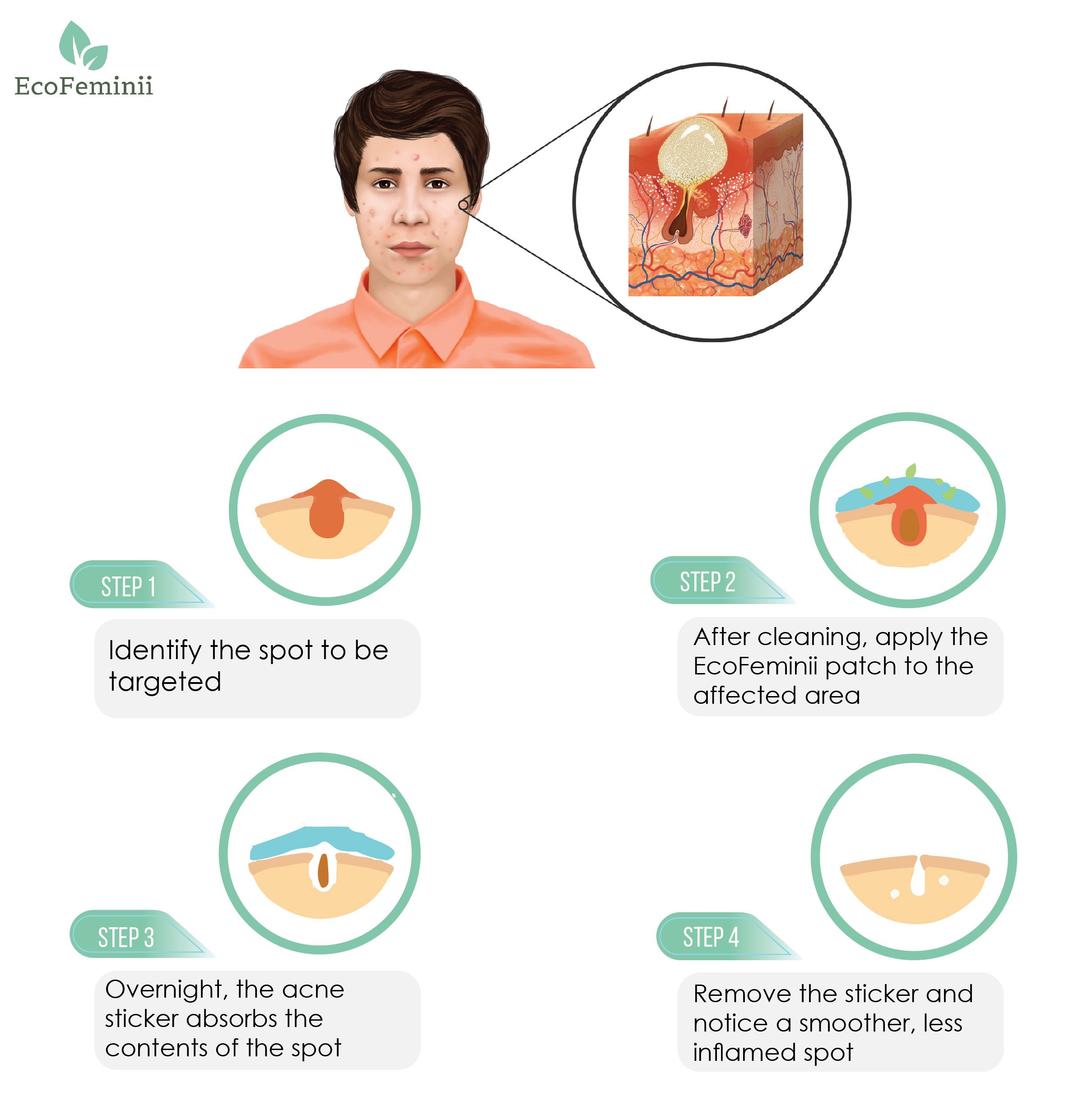 EcoFeminii Pack of 108 Targeted Acne Treatment Sticker Patches - Absorbing Hydrocolloid Covers for Spot Repair - Transparent Dots for Blemishes - Natural and Effective on Oily or Combination Skin - Overnight Acne, Spot and Blackhead Treatme