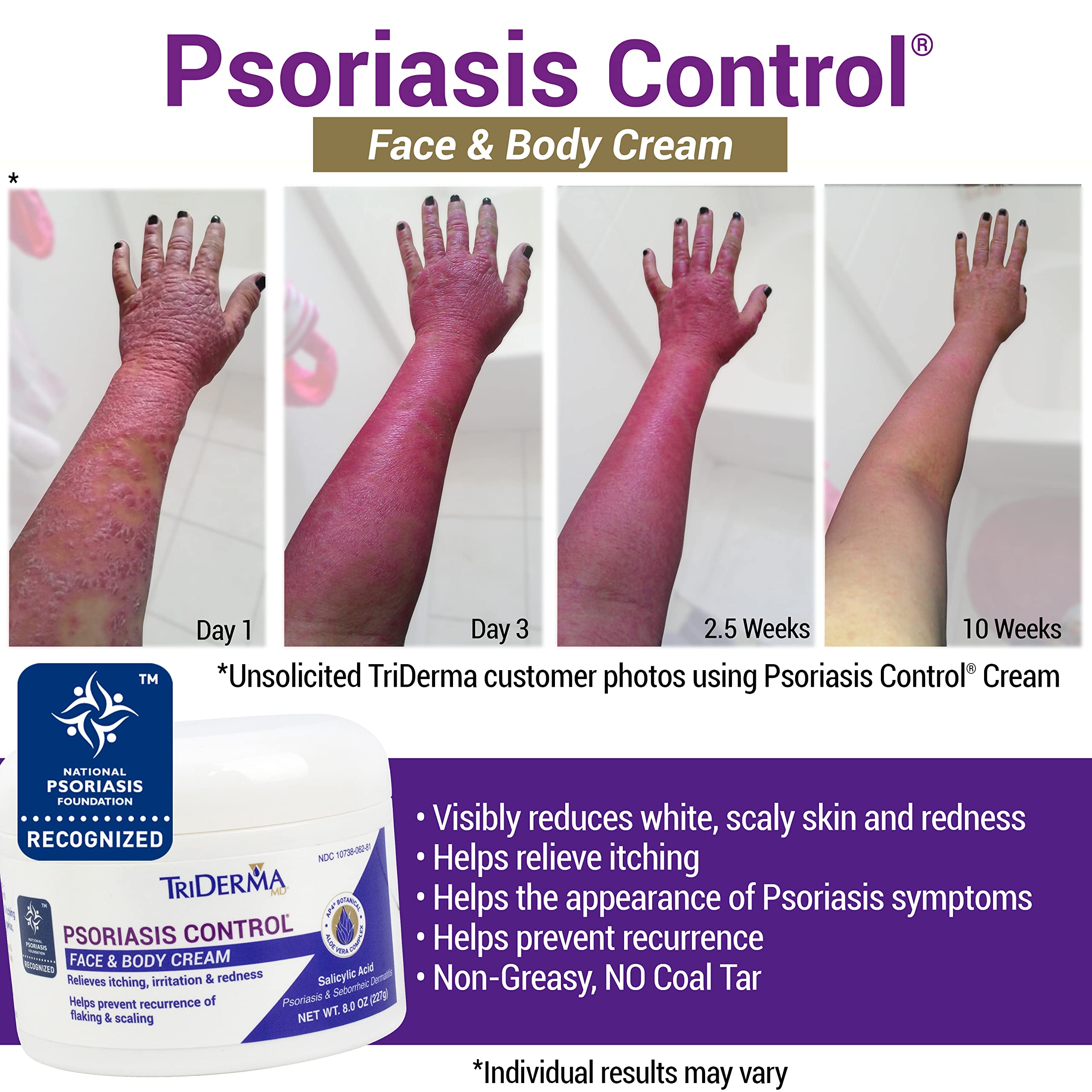 TriDerma Psoriasis Control Face & Body Cream - Maximum Strength 3% Salicylic Acid - Moisturizing Psoriasis Cream (No Cortisone, Fragrance or Parabens) - 8 Oz Jar