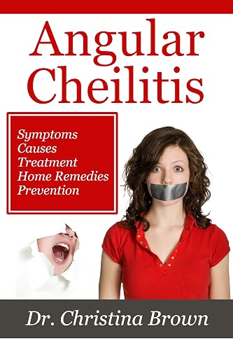 Angular Cheilitis: Symptoms, Causes,Treatment, Home Remedies ...