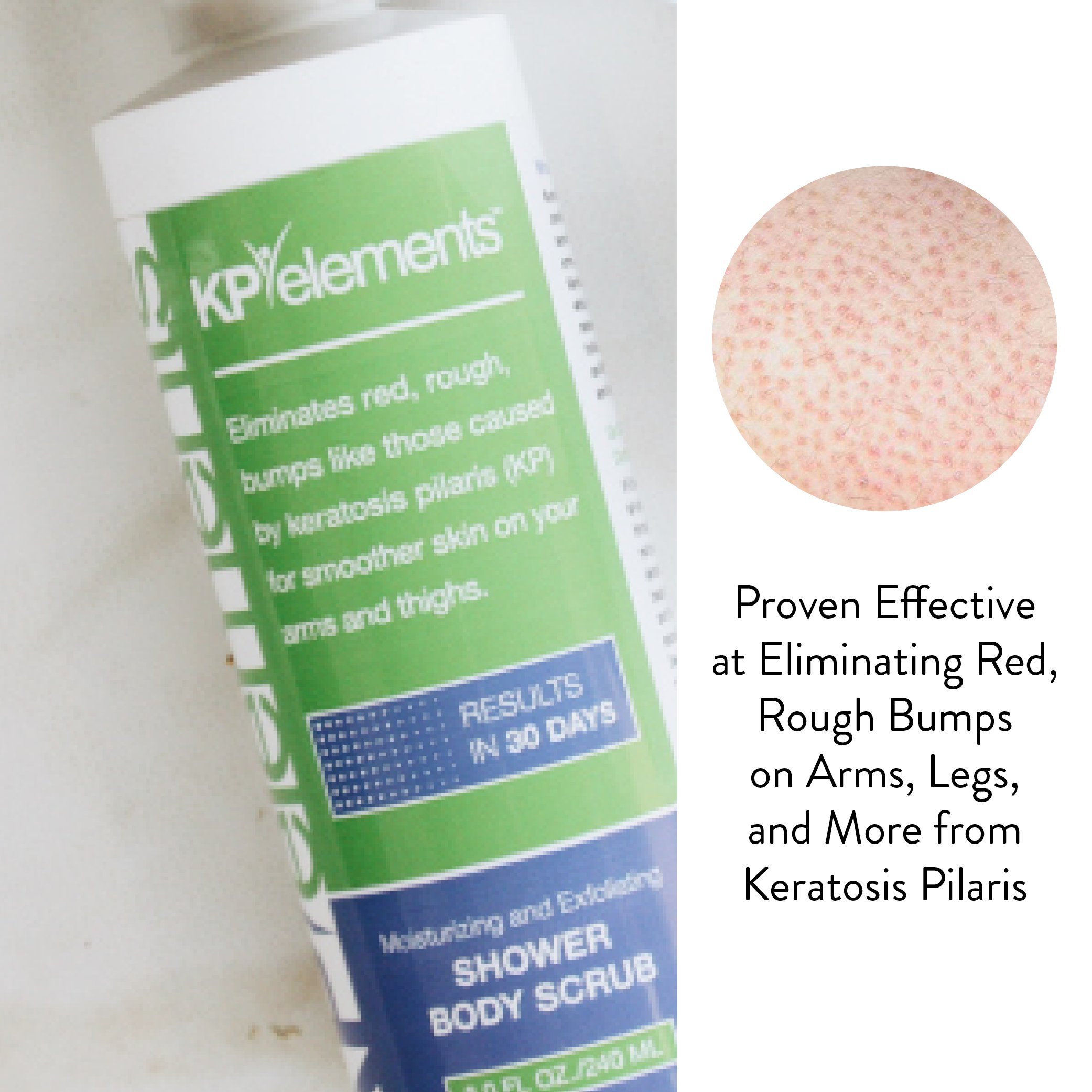 KP Elements Keratosis Pilaris Body Scrub Treatments, 8 fl oz. All