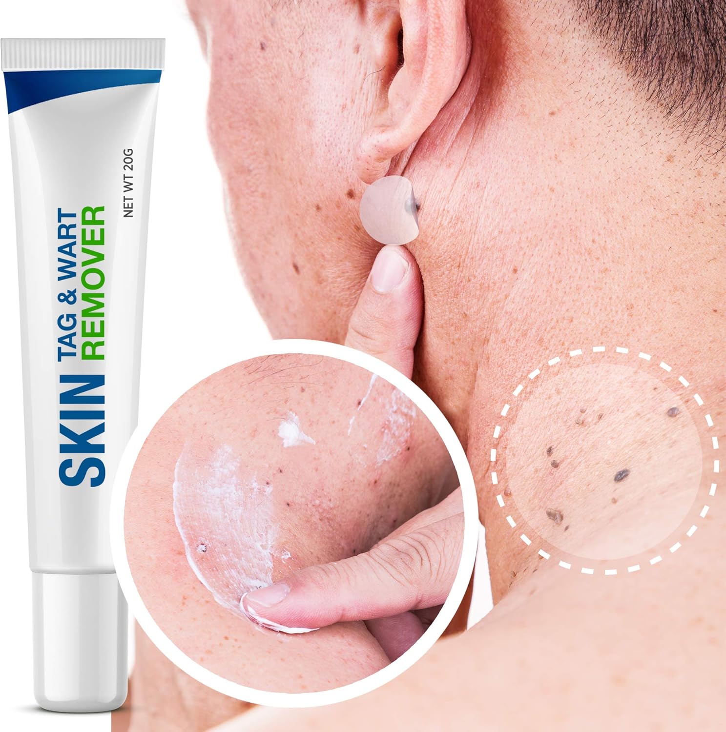 Pureskin Safe & Effective Formula Skin Tag Remover Patches Set, Skin Tag Removal Patches Set with Natural Ingredients for Your Skin Tag: Health & Personal Care