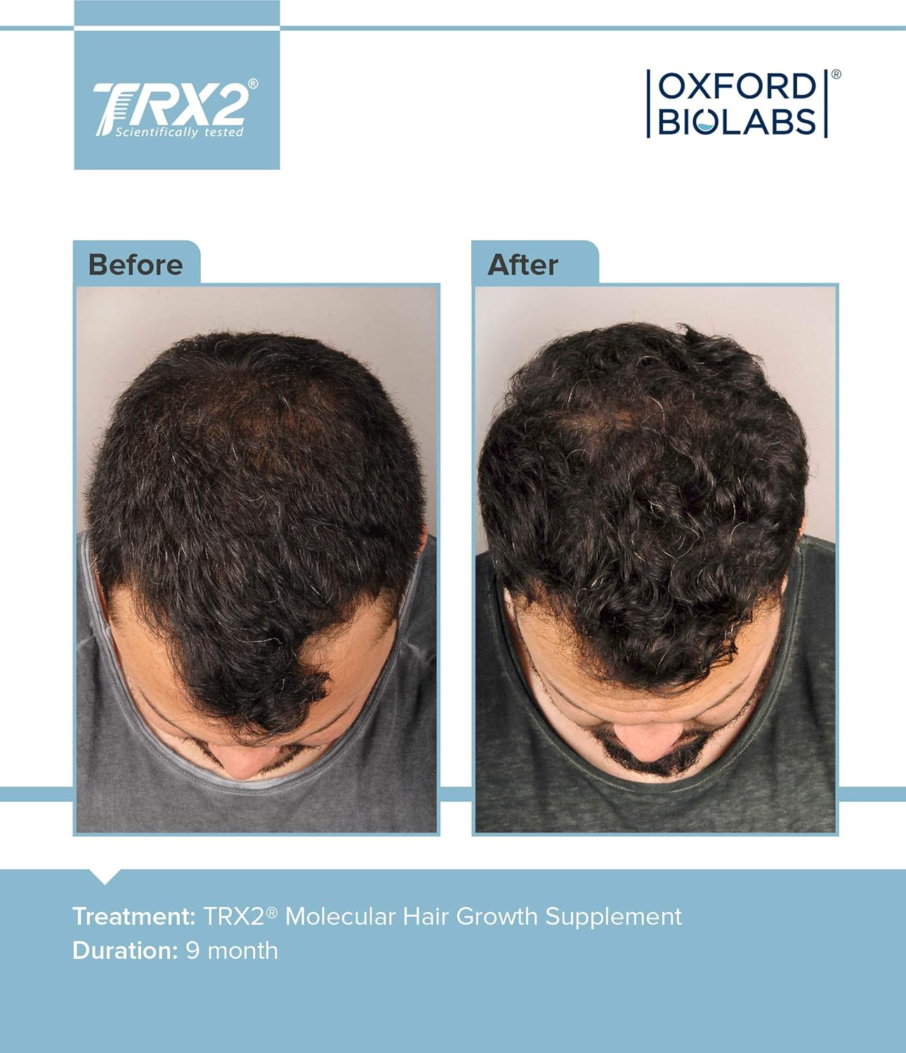 Trx2 Molecular Hair Growth Supplements Amazon Ca Health Personal Care