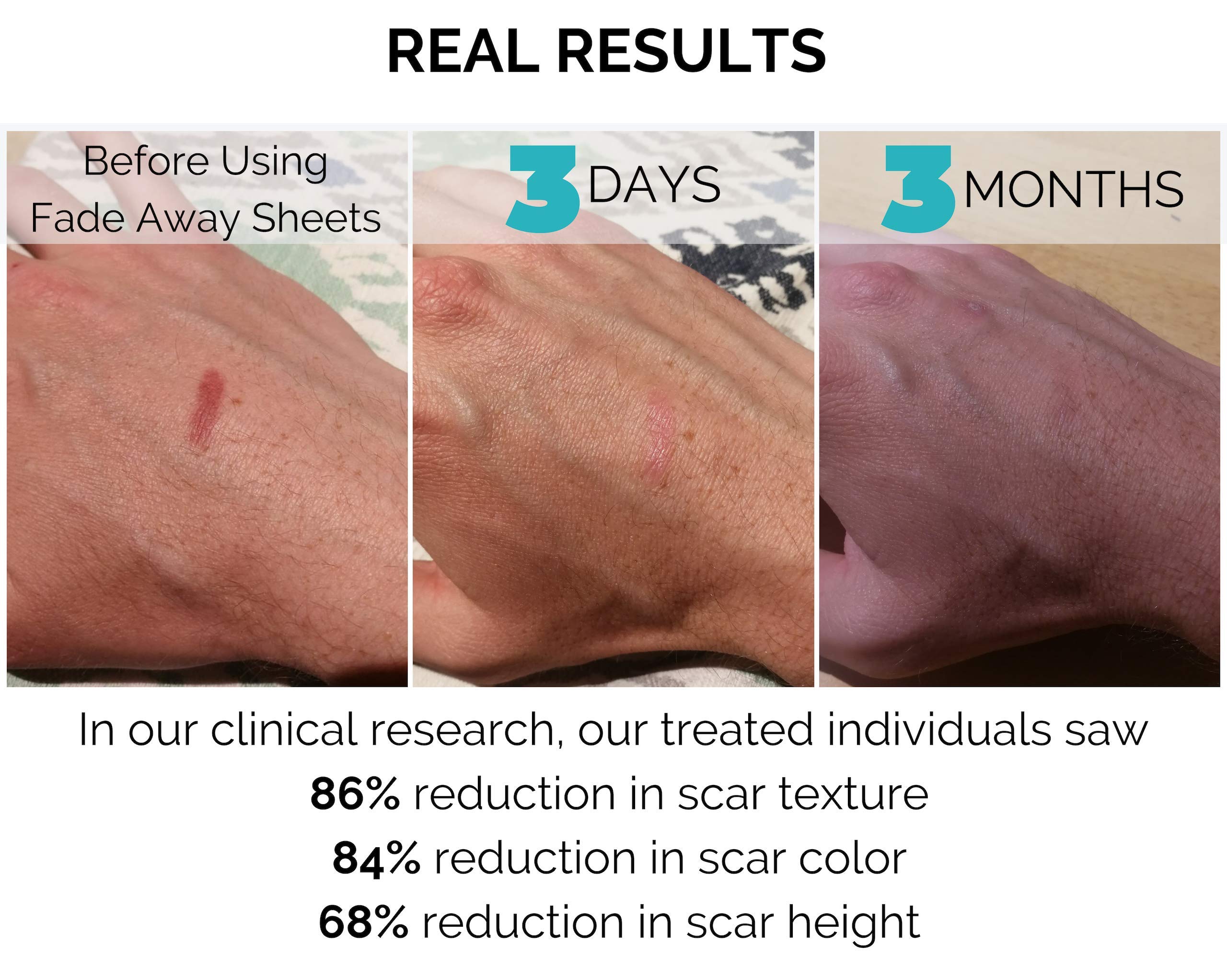 6ft TrimtoSize Roll Fade Away Silicone Gel Scar Treatment Sheets