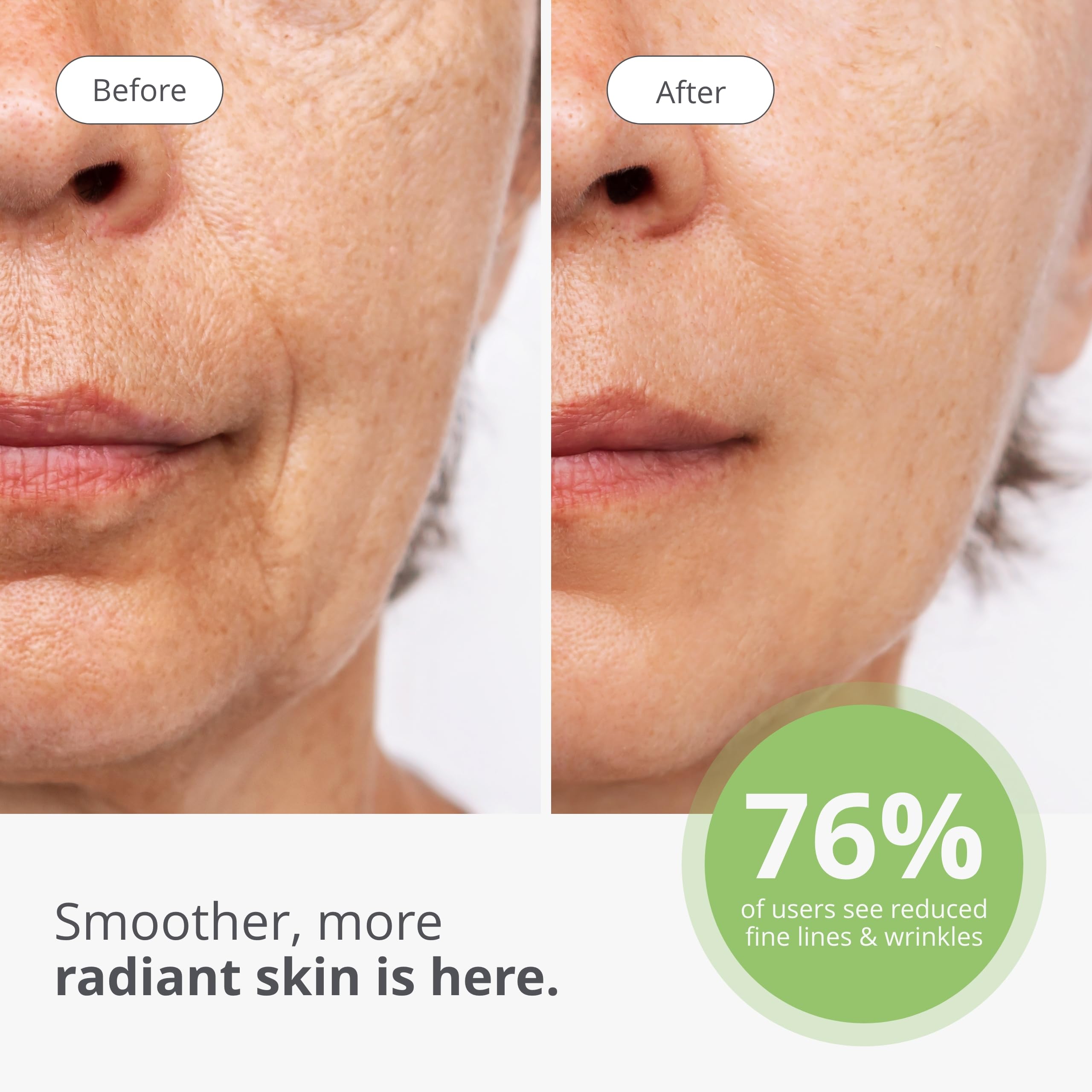 Tria Age-Defying SmoothBeauty Laser - Anti-Aging Skin Care Face Machine - Lilac