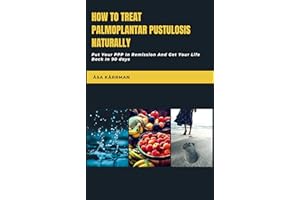How To Treat Palmoplantar Pustulosis Naturally: Put Your PPP In Remission And Get Your Life Back on 90 days.