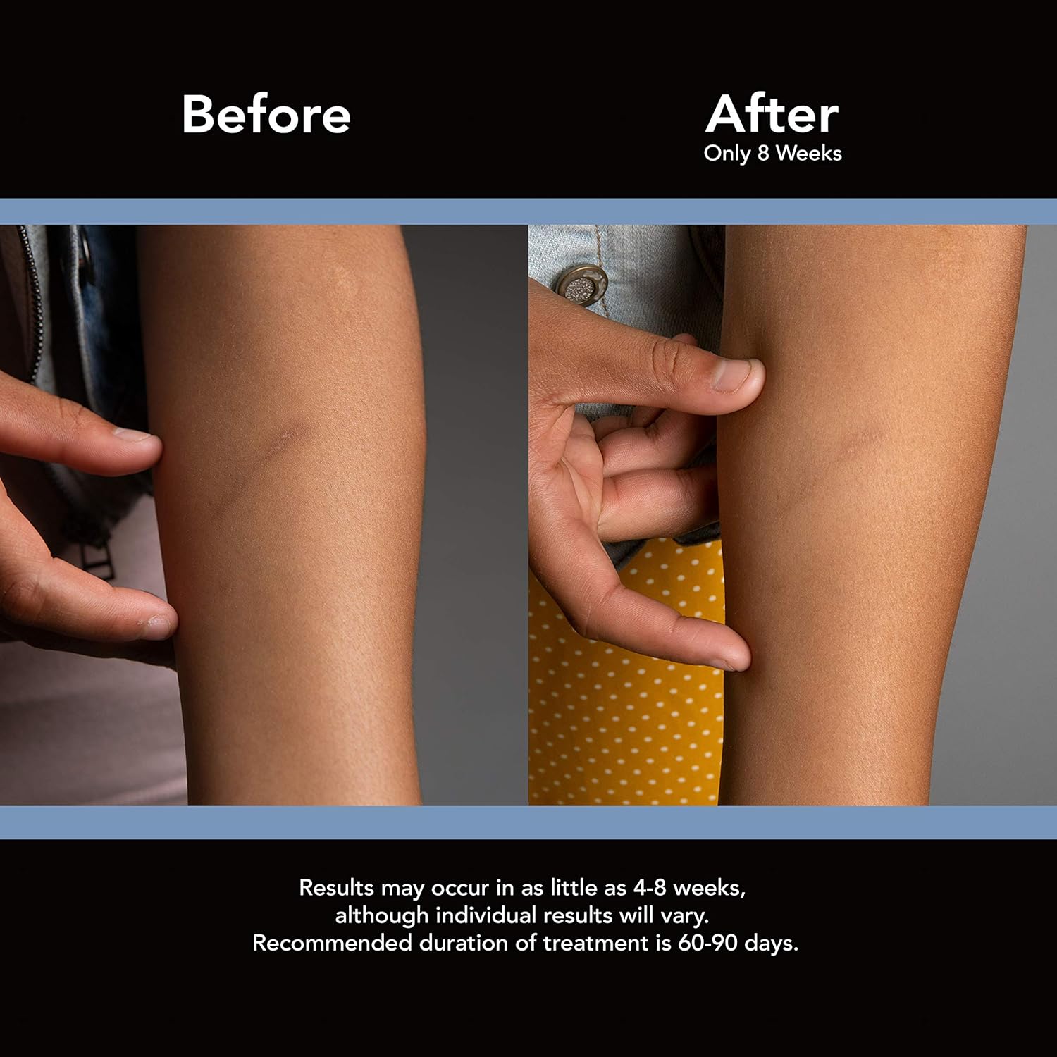 ScarAway Advanced Skincare Silicone Scar Sheets for Face, Body, Surgical, Burn, Hypertrophic Scars, Keloids and Acne Scar Treatment: Health & Personal Care