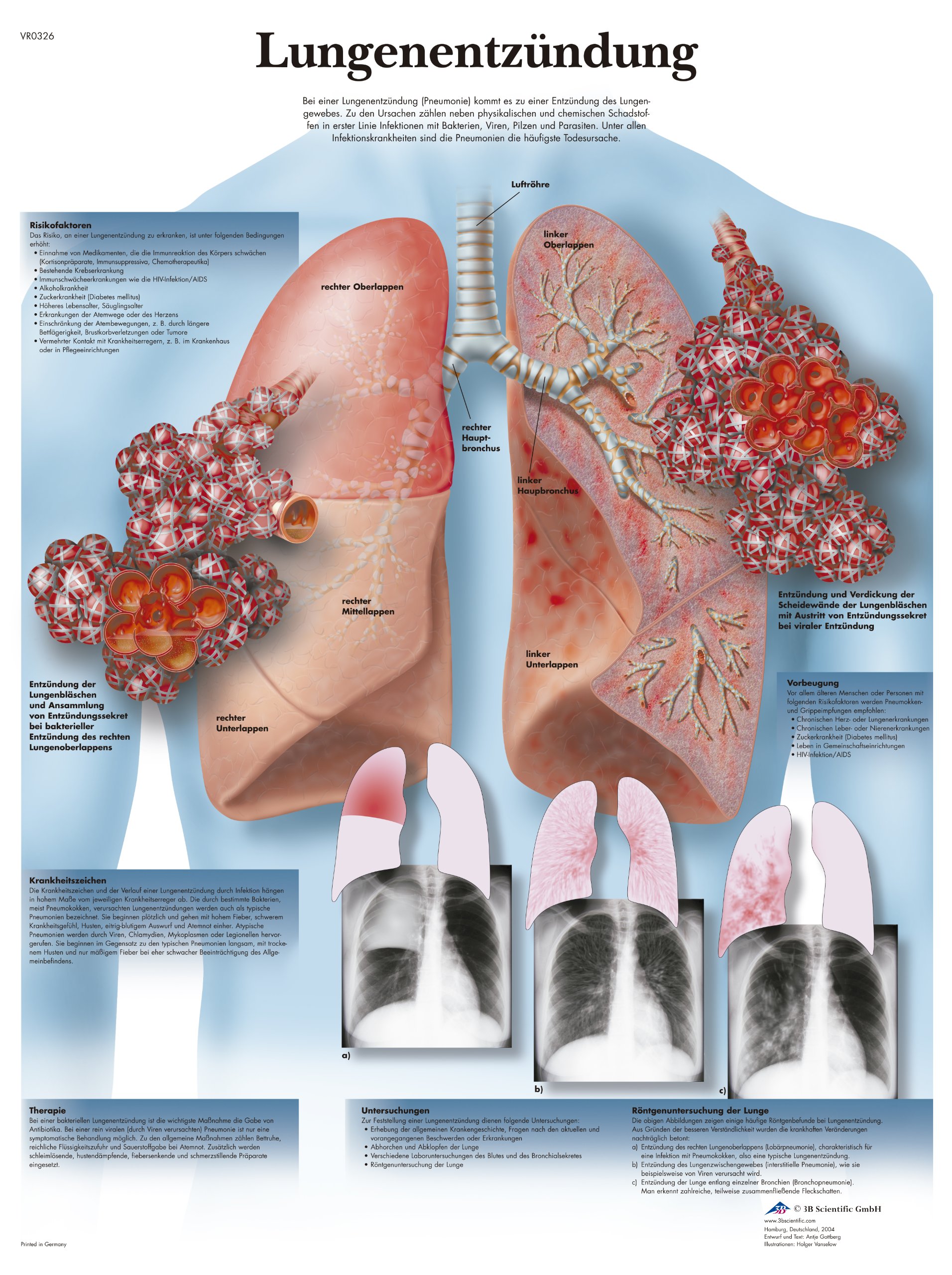 3B Scientific Chart Laminated with Pneumonia, 1