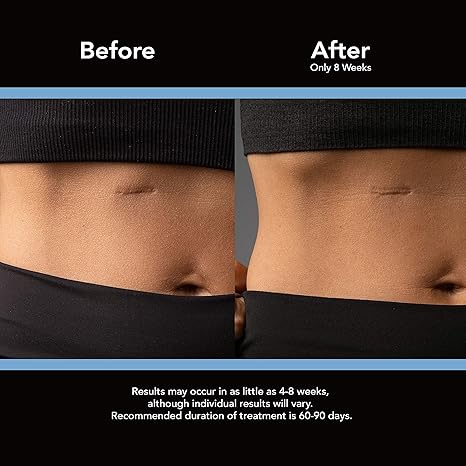 Scaraway 100 Medical Grade Silicone Scar Gel For Face Body Surgical Burn Hypertrophic Scars Keloids And Acne Scar Treatment 0 71 Ounces 20 Grams Scar Reducing Treatments Beauty Amazon Com